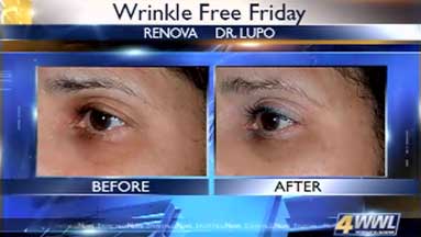 tri luma for wrinkles