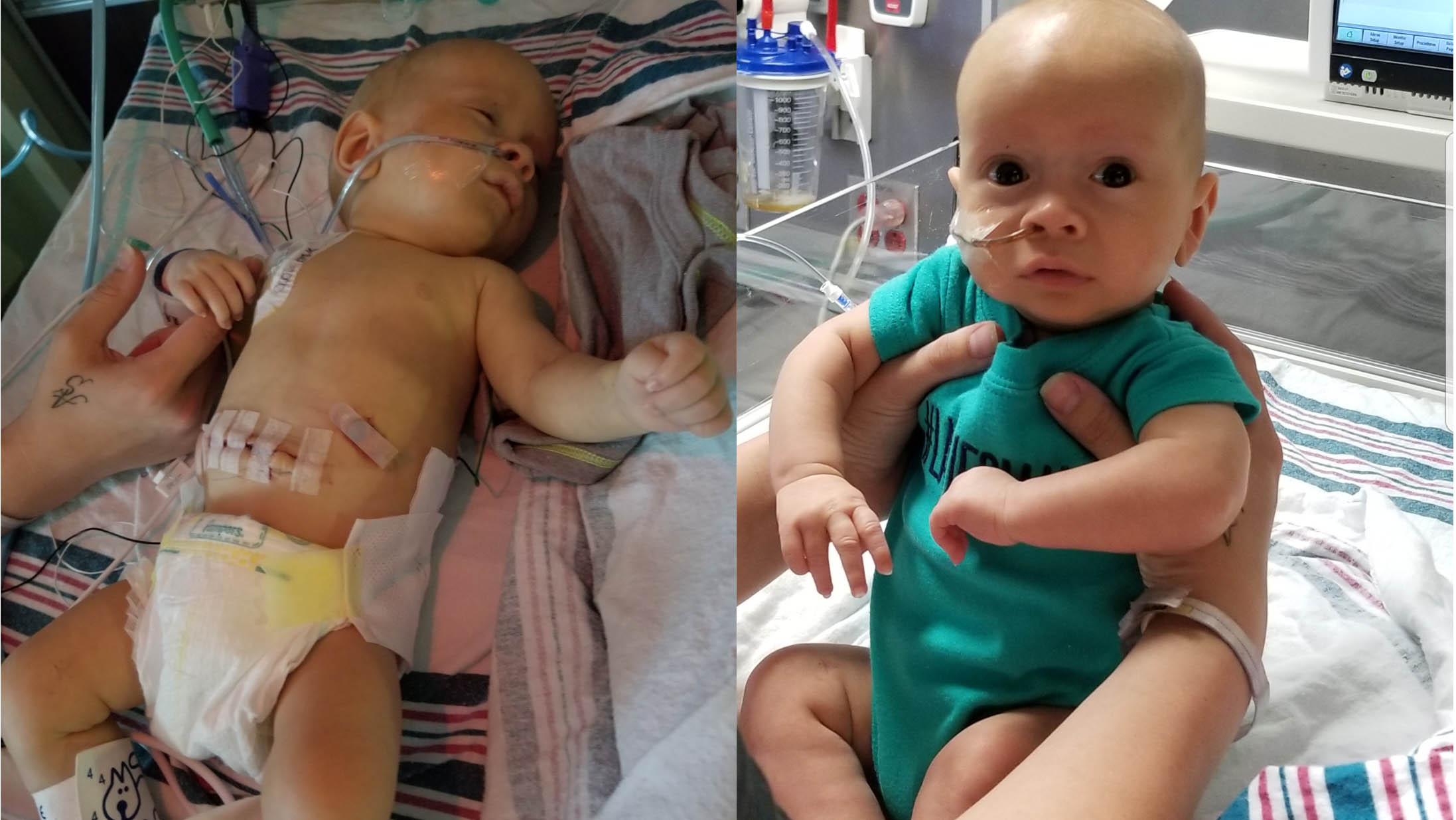 wwltv-baby-born-with-hole-in-his-stomach-fighting-for-his-life